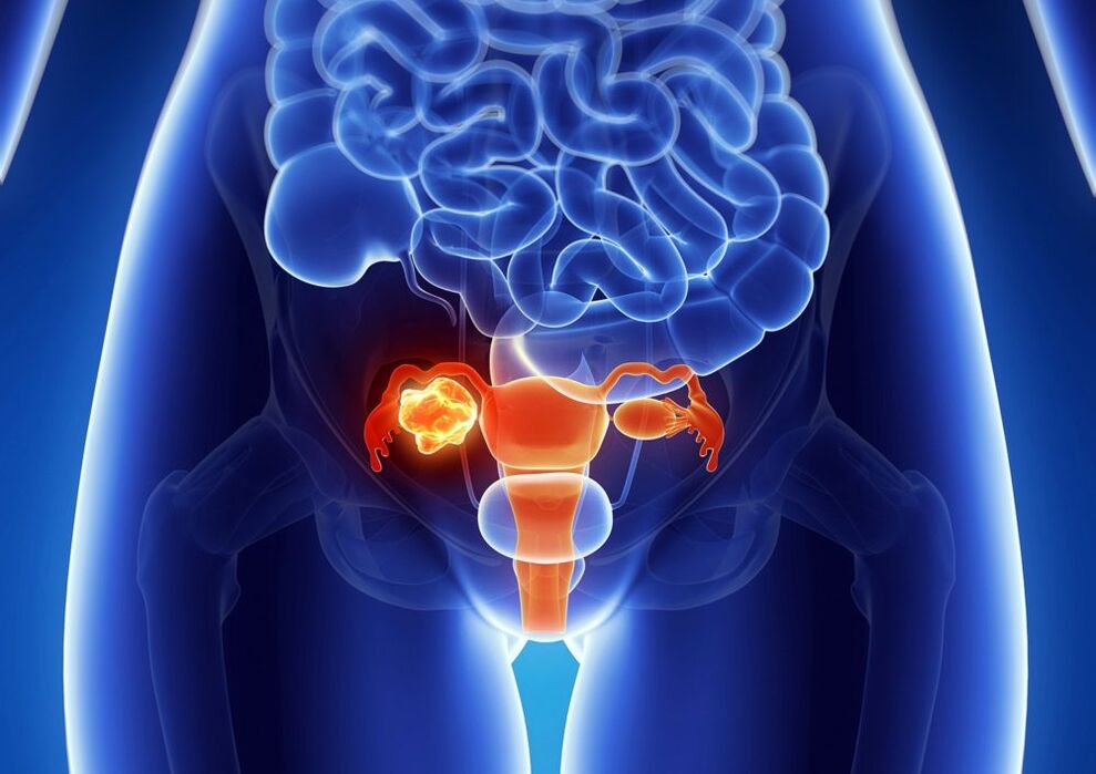 Woman's ovary pathology under the influence of alcohol